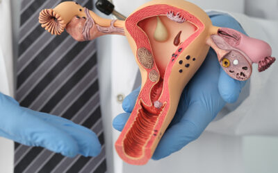 Câncer do corpo do útero: fatores de risco, sintomas e tratamentos